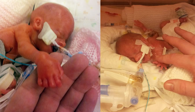 Miracle of baby born at 19 weeks