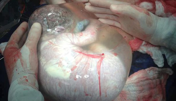 Baby born still inside its amniotic sac