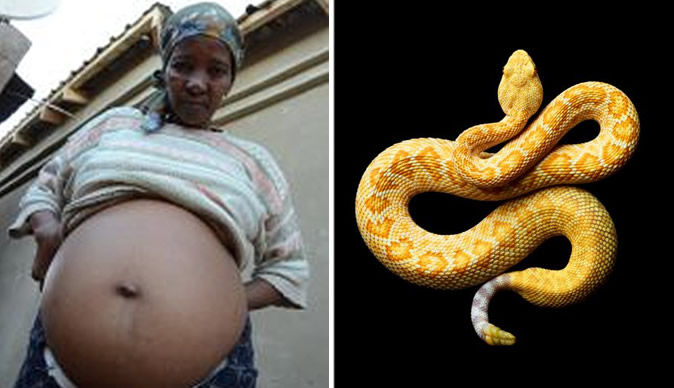 Woman has 'snake inside her stomach'