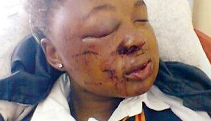 School girl badly beaten up on her way to school