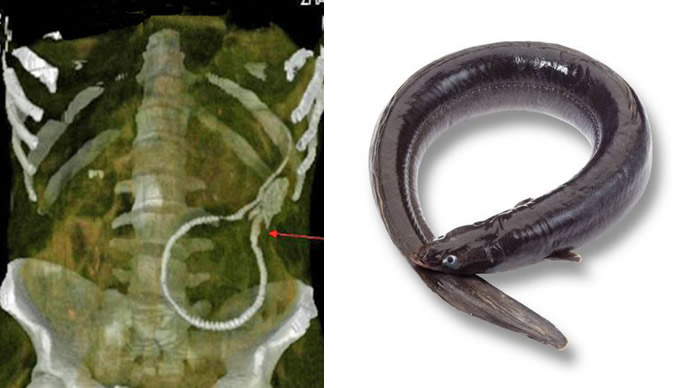 Man stuns medics with live eel stuck up his bum