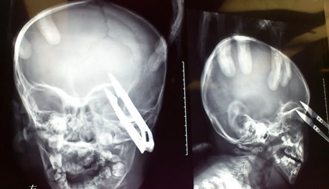 Boy survives falling headfirst on to scissors