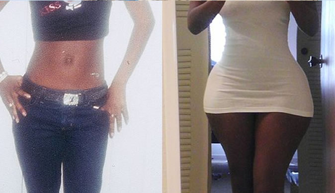 Bum-boosting injections leaves petite women with XL bottom 