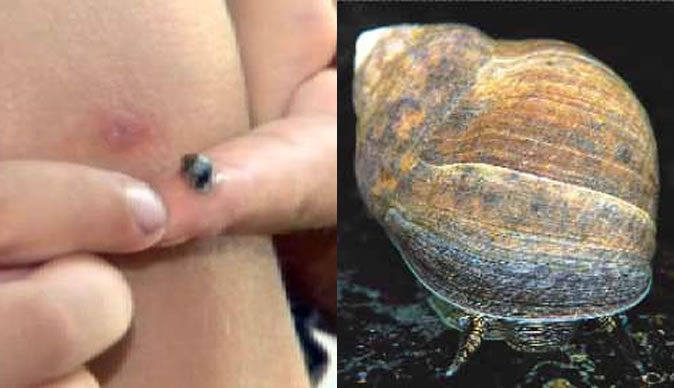 Sea snail hatches inside boy's knee